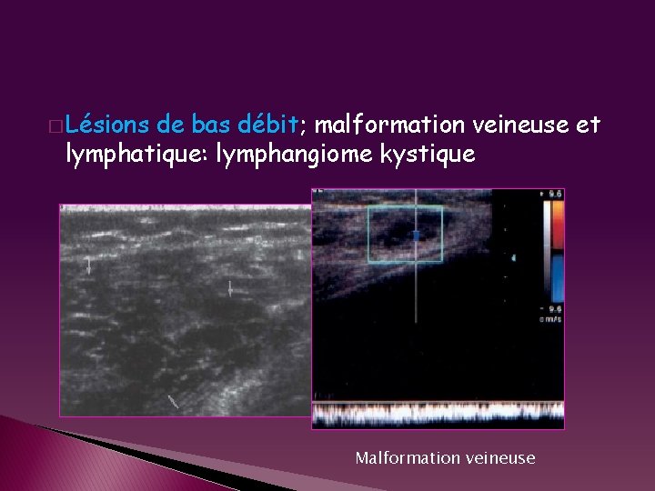 � Lésions de bas débit; malformation veineuse et lymphatique: lymphangiome kystique Malformation veineuse 