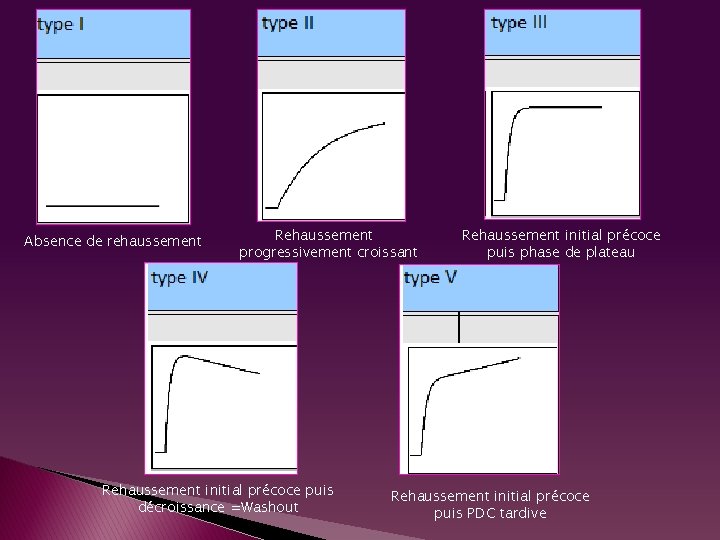 Absence de rehaussement Rehaussement progressivement croissant Rehaussement initial précoce puis décroissance =Washout Rehaussement initial