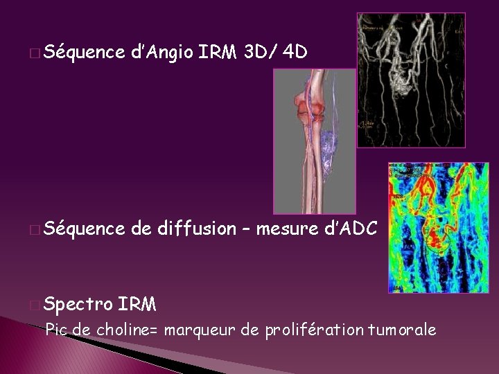 � Séquence d’Angio IRM 3 D/ 4 D � Séquence de diffusion – mesure