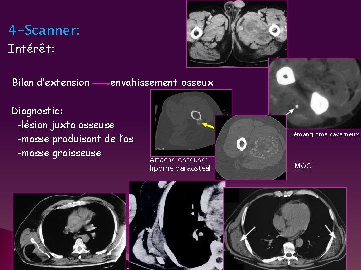 4 -Scanner: Intérêt: Bilan d’extension envahissement osseux Diagnostic: -lésion juxta osseuse -masse produisant de