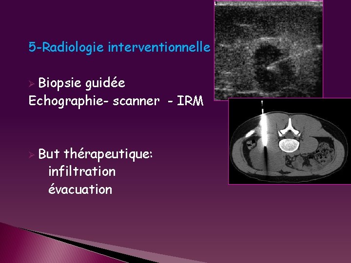 5 -Radiologie interventionnelle Ø Biopsie guidée Echographie- scanner - IRM Ø But thérapeutique: infiltration