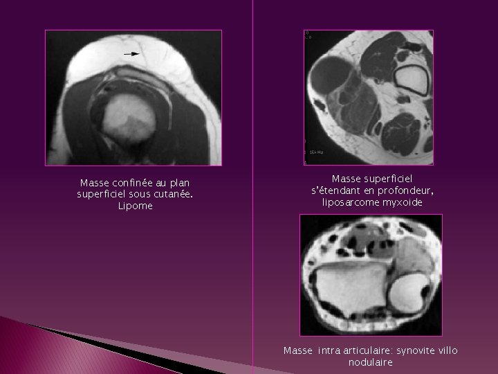 Masse confinée au plan superficiel sous cutanée. Lipome Masse superficiel s’étendant en profondeur, liposarcome