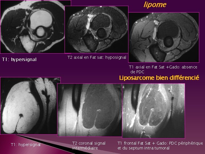 lipome T 1: hypersignal T 2 axial en Fat sat: hyposignal T 1 axial