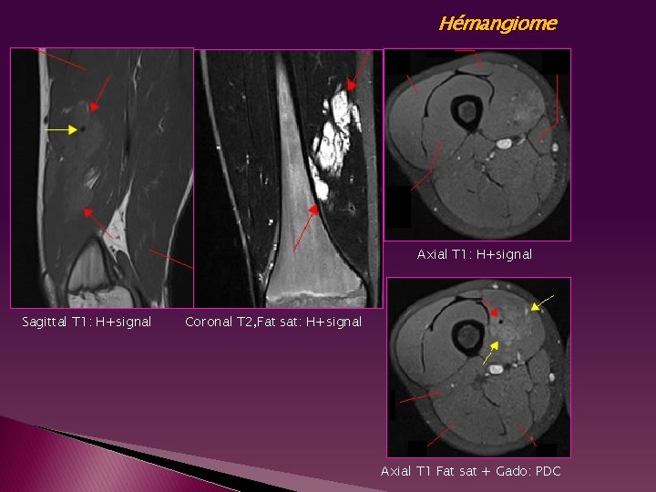 Hémangiome Axial T 1: H+signal Sagittal T 1: H+signal Coronal T 2, Fat sat: