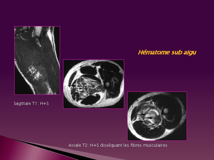 Hématome sub aigu Sagittale T 1: H+S Axiale T 2: H+S disséquant les fibres