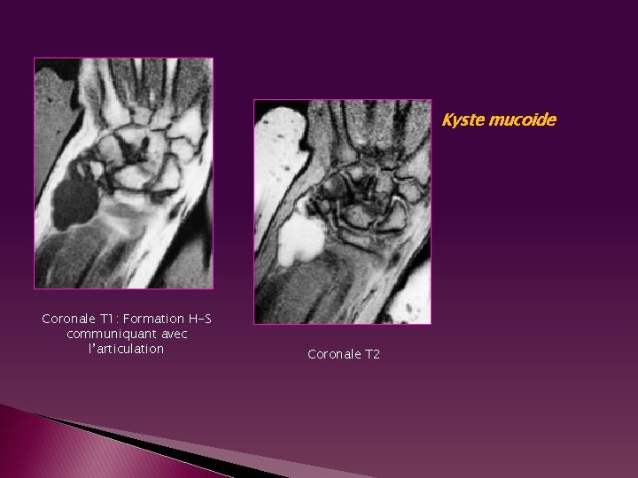 Kyste mucoide Coronale T 1: Formation H-S communiquant avec l’articulation Coronale T 2 