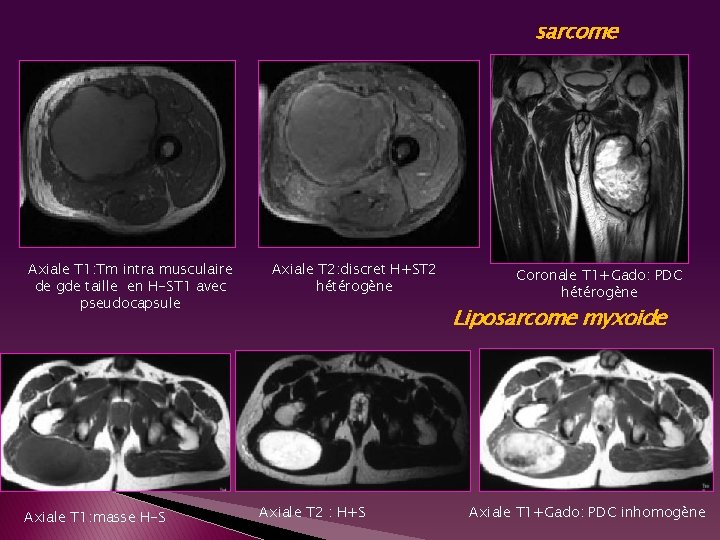 sarcome Axiale T 1: Tm intra musculaire de gde taille en H-ST 1 avec