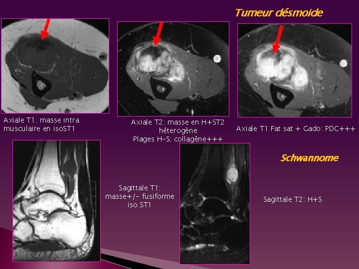 Tumeur désmoide Axiale T 1: masse intra musculaire en iso. ST 1 Axiale T