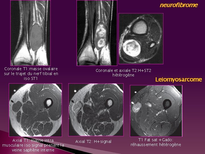 neurofibrome Coronale T 1: masse ovalaire sur le trajet du nerf tibial en iso