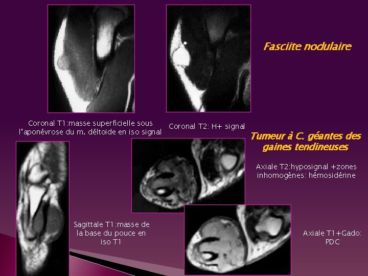 Fasciite nodulaire Coronal T 1: masse superficielle sous Coronal T 2: H+ signal l’aponévrose