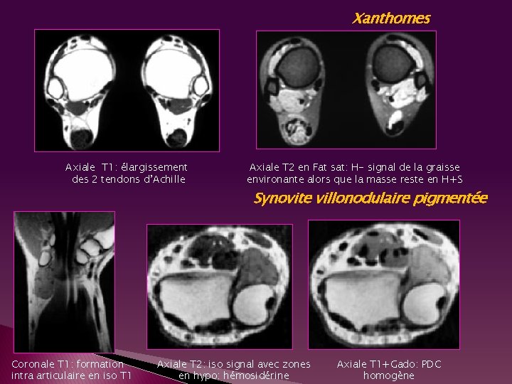 Xanthomes Axiale T 1: élargissement des 2 tendons d’Achille Coronale T 1: formation intra