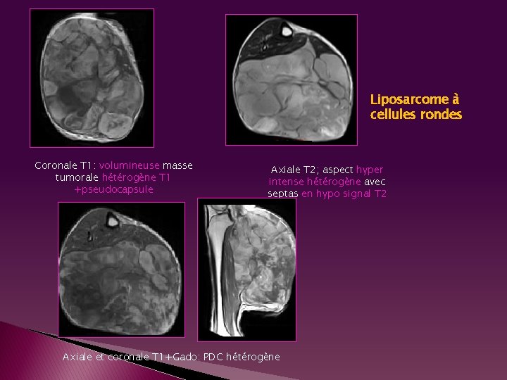 Liposarcome à cellules rondes Coronale T 1: volumineuse masse tumorale hétérogène T 1 +pseudocapsule