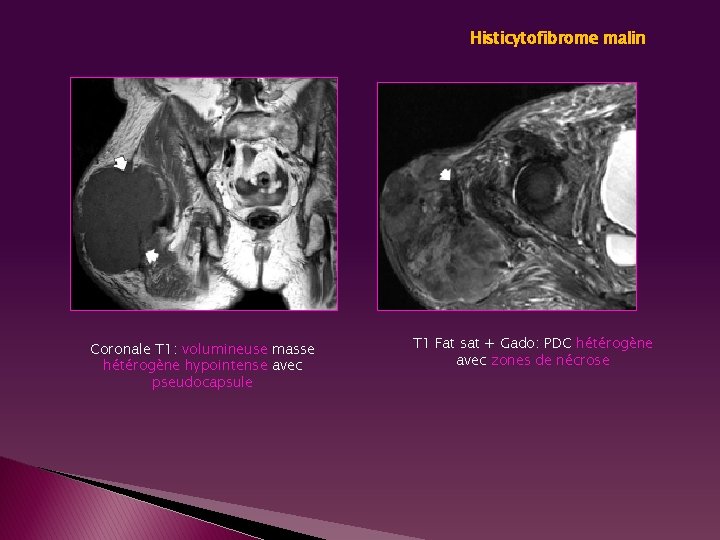 Histicytofibrome malin Coronale T 1: volumineuse masse hétérogène hypointense avec pseudocapsule T 1 Fat