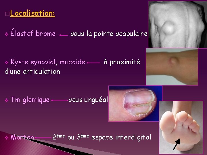 � Localisation: v Élastofibrome sous la pointe scapulaire Kyste synovial, mucoide d’une articulation v