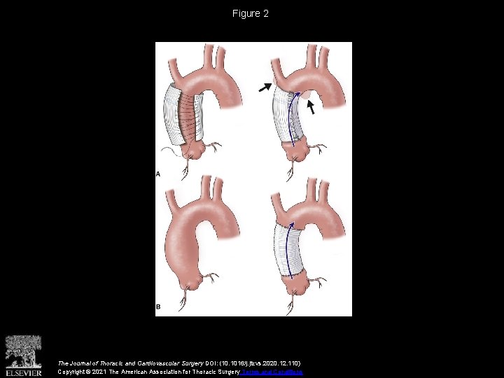 Figure 2 The Journal of Thoracic and Cardiovascular Surgery DOI: (10. 1016/j. jtcvs. 2020.