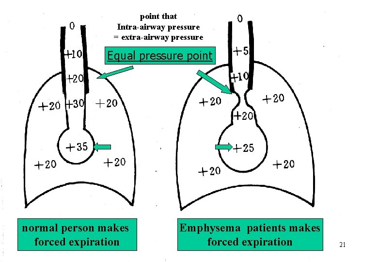 point that Intra-airway pressure = extra-airway pressure Equal pressure point normal person makes forced