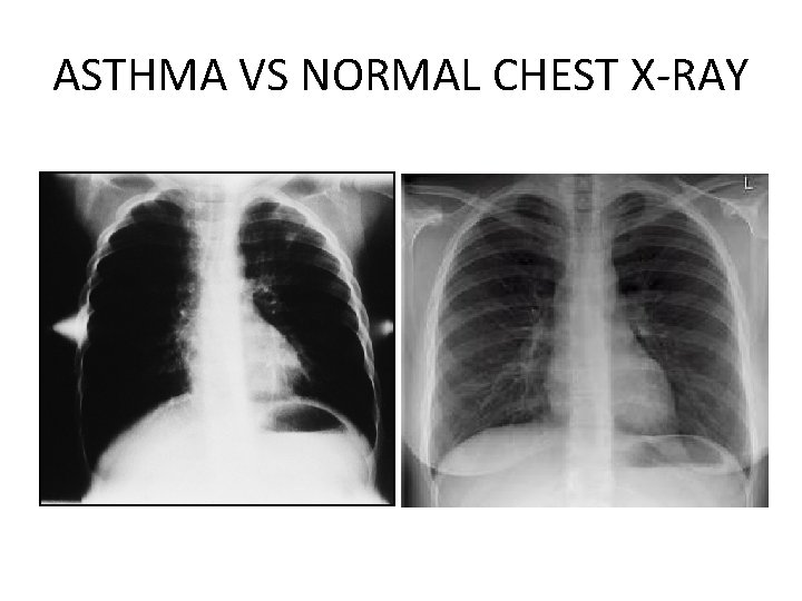 ASTHMA VS NORMAL CHEST X-RAY 