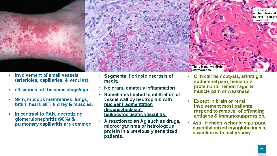 § Involvement of small vessels (arterioles, capillaries, & venules). § all lesions of the