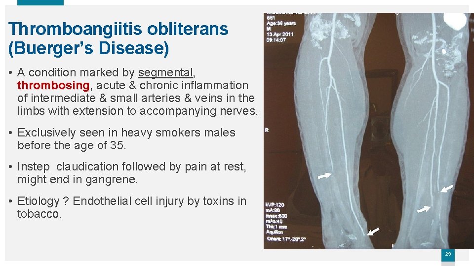 Thromboangiitis obliterans (Buerger’s Disease) • A condition marked by segmental, thrombosing acute & chronic