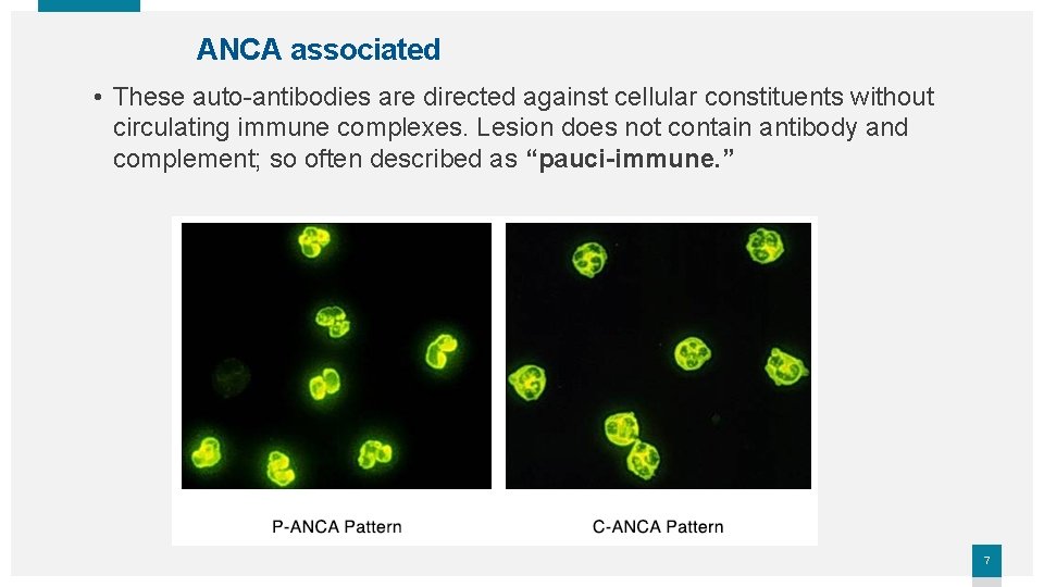 ANCA associated • These auto-antibodies are directed against cellular constituents without circulating immune complexes.