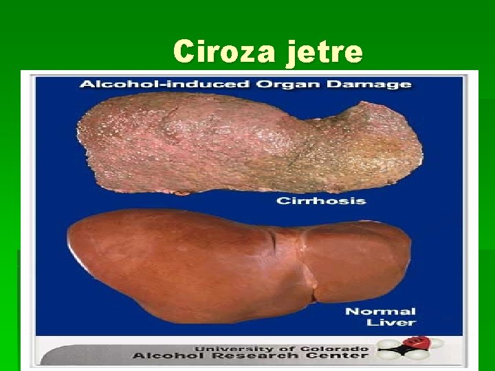 Ciroza jetre 