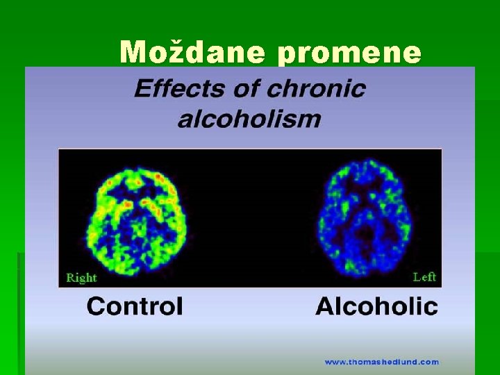 Moždane promene 