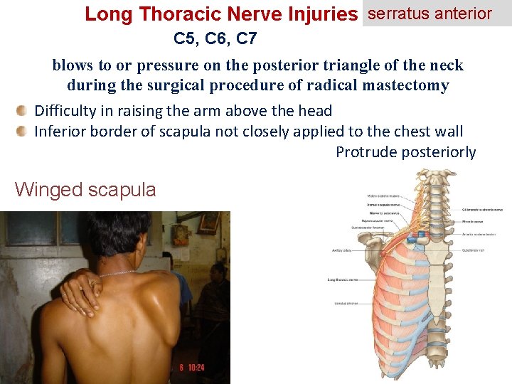 Long Thoracic Nerve Injuries serratus anterior C 5, C 6, C 7 blows to