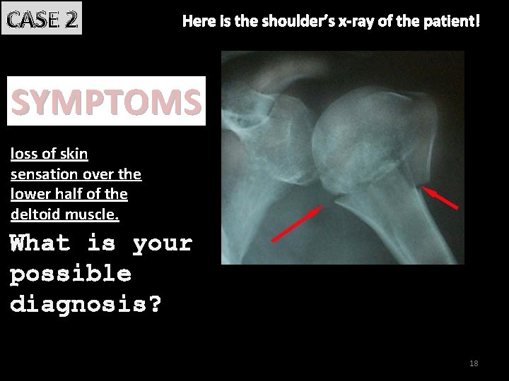CASE 2 Here is the shoulder’s x-ray of the patient! SYMPTOMS loss of skin