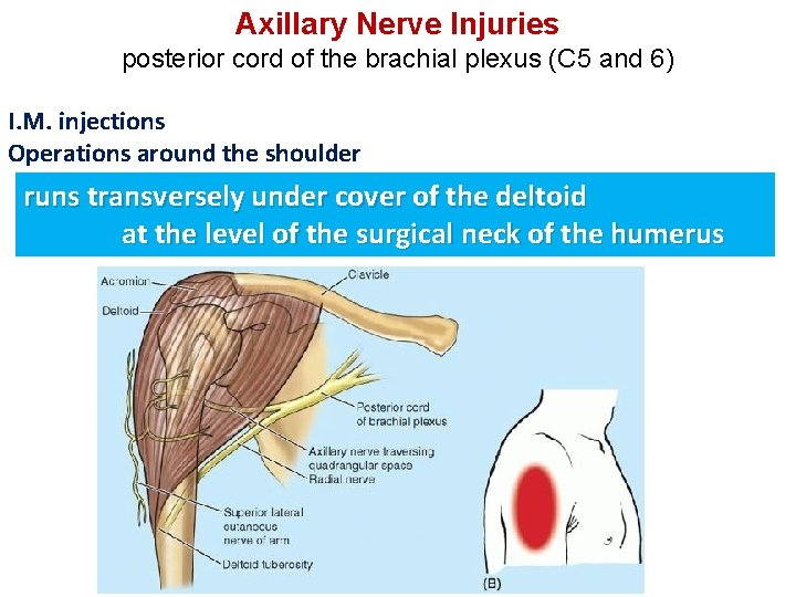 Axillary Nerve Injuries posterior cord of the brachial plexus (C 5 and 6) I.