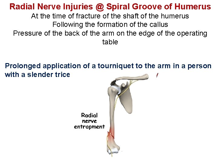 Radial Nerve Injuries @ Spiral Groove of Humerus At the time of fracture of