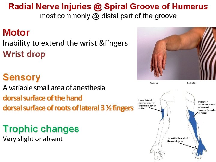 Radial Nerve Injuries @ Spiral Groove of Humerus most commonly @ distal part of