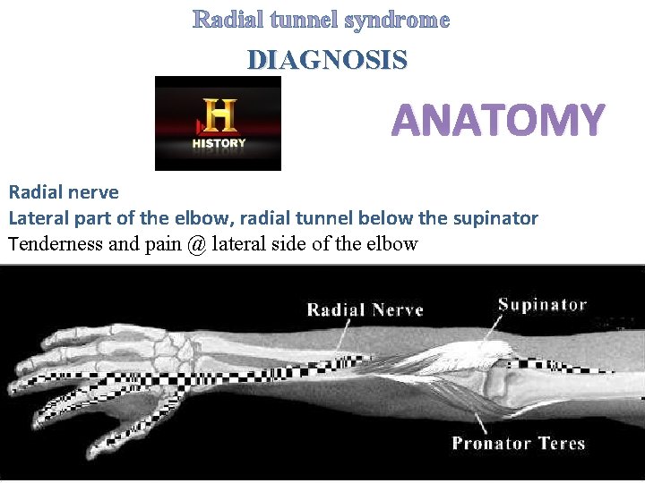 Radial tunnel syndrome DIAGNOSIS ANATOMY Radial nerve Lateral part of the elbow, radial tunnel