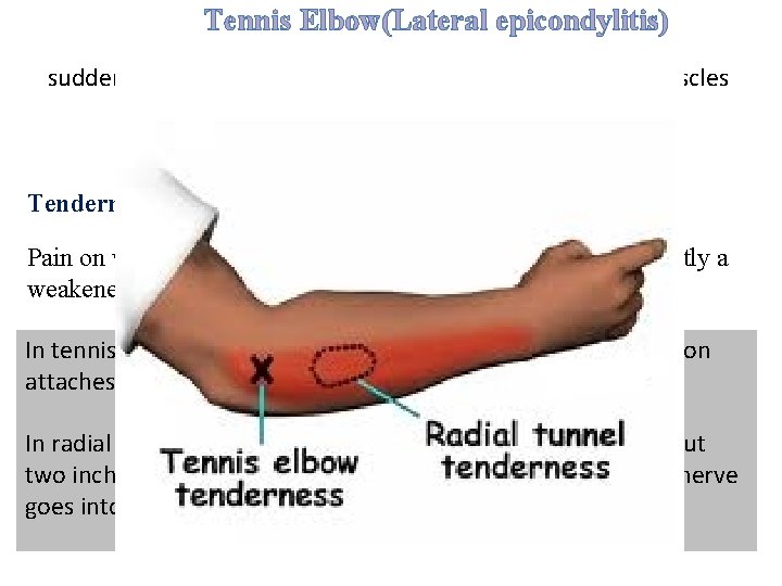 Tennis Elbow(Lateral epicondylitis) sudden and often repeated use of the forearm extensor muscles previously