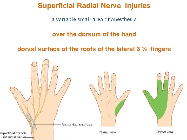 Superficial Radial Nerve Injuries a variable small area of anesthesia over the dorsum of
