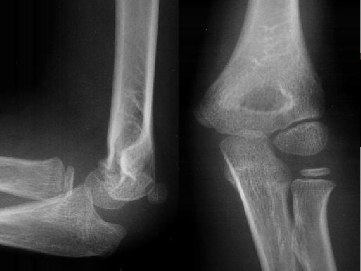 Median Nerve Injuries occasionally in the elbow region supracondylar fractures of the humerus most