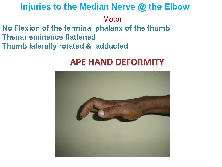 Injuries to the Median Nerve @ the Elbow Motor No Flexion of the terminal