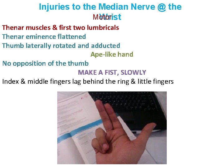 Injuries to the Median Nerve @ the Motor Wrist Thenar muscles & first two