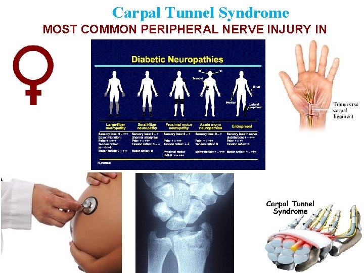 Carpal Tunnel Syndrome MOST COMMON PERIPHERAL NERVE INJURY IN THE UPPER LIMB 