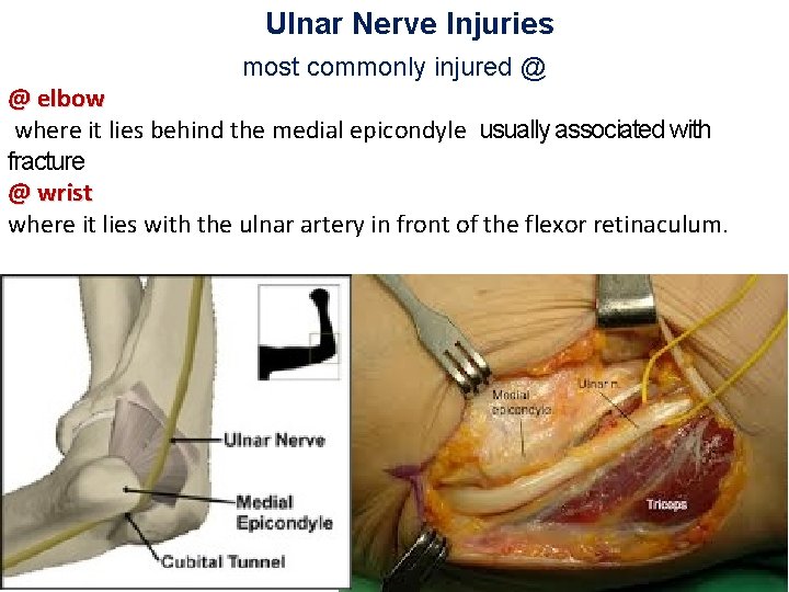 Ulnar Nerve Injuries most commonly injured @ @ elbow where it lies behind the
