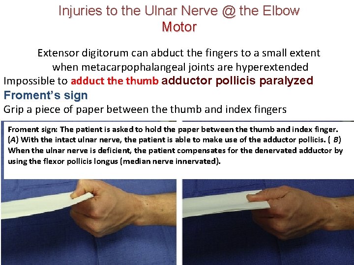 Injuries to the Ulnar Nerve @ the Elbow Motor Extensor digitorum can abduct the