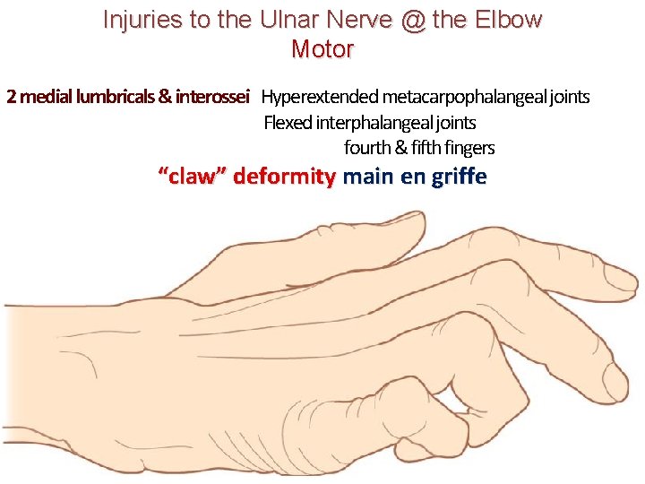 Injuries to the Ulnar Nerve @ the Elbow Motor 2 medial lumbricals & interossei