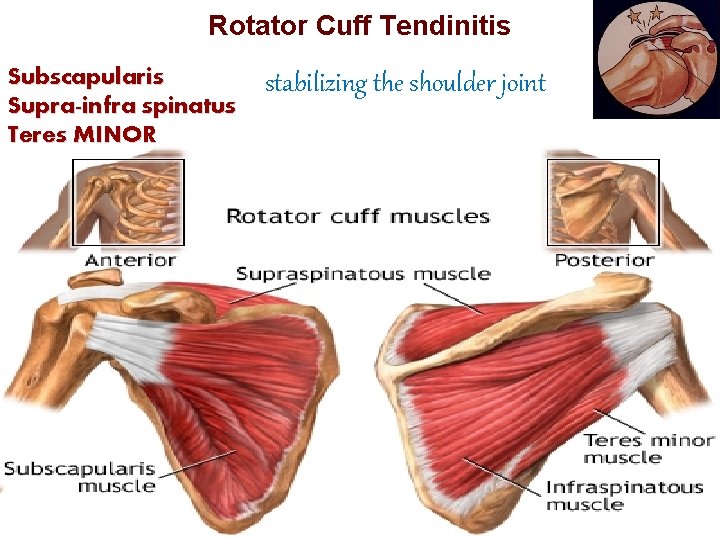 Rotator Cuff Tendinitis Subscapularis stabilizing the shoulder joint Supra-infra spinatus Teres MINOR Lesions of