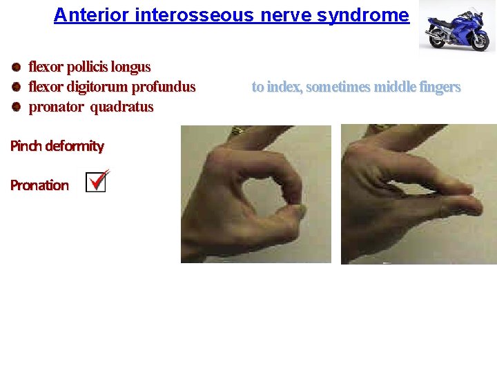 Anterior interosseous nerve syndrome flexor pollicis longus flexor digitorum profundus pronator quadratus Pinch deformity