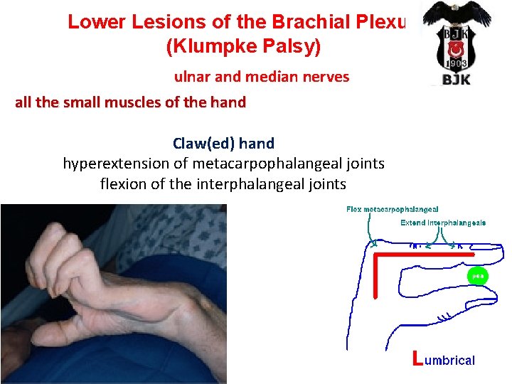 Lower Lesions of the Brachial Plexus (Klumpke Palsy) ulnar and median nerves all the