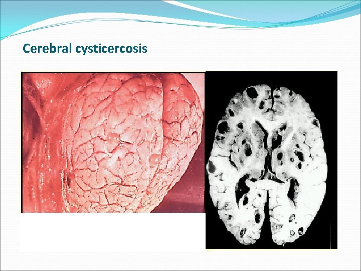 Cerebral cysticercosis 