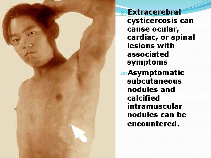  Extracerebral cysticercosis can cause ocular, cardiac, or spinal lesions with associated symptoms Asymptomatic