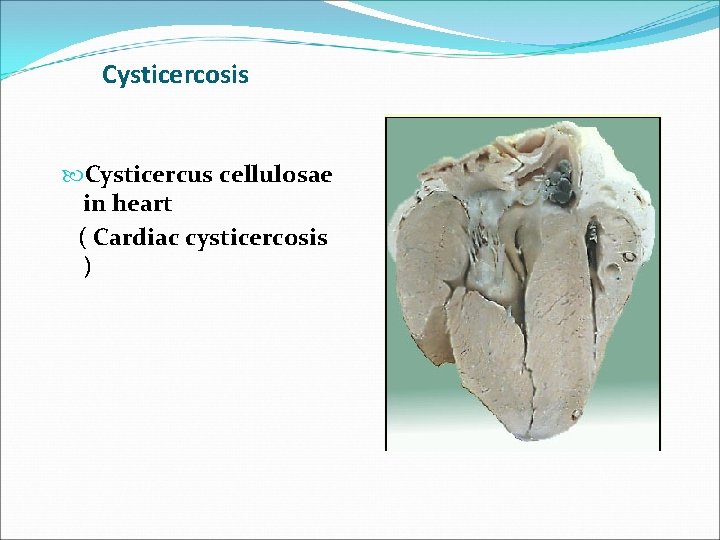 Cysticercosis Cysticercus cellulosae in heart ( Cardiac cysticercosis ) 