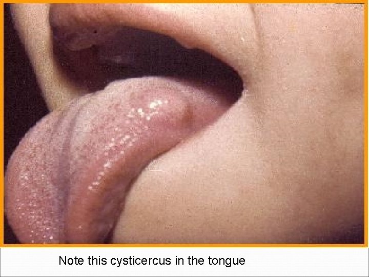  Note this cysticercus in the tongue 