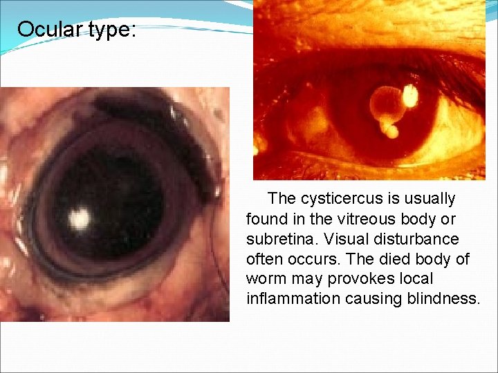 Ocular type: The cysticercus is usually found in the vitreous body or subretina. Visual
