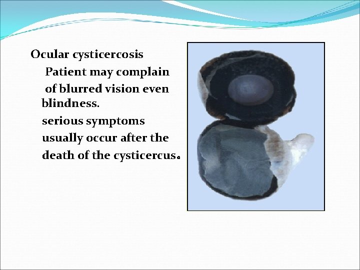 Ocular cysticercosis Patient may complain of blurred vision even blindness. serious symptoms usually occur